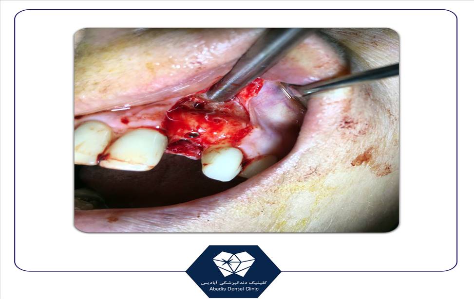 جراحی های لثه ای و دندانی