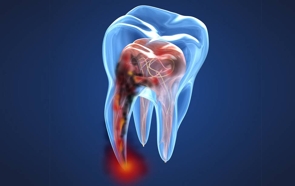 Root canal therapy or root canal treatment