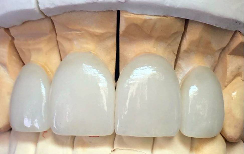 Dental veneers