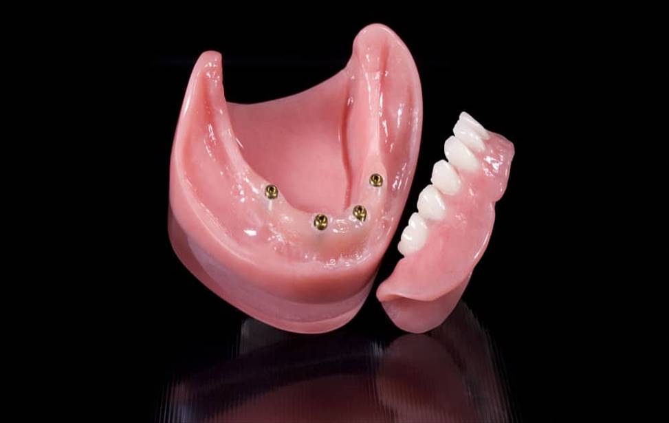 Fixed dentures